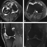 Fig. 1 Axial (Figs. 1-A and 1-B), sagittal (Fig. 1-C), and coronal (Fig. 1-D) T2-weighted MRI of the knee demonstrating multiple discrete lesions in the infrapatellar region (Figs. 1-A and 1-B), Hoffa fat pad (Fig. 1-C), and femoral notch (Fig. 1-D).
