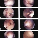 Fig. 2 Intraoperative photographs demonstrate discrete lesions in the infrapatellar region (Figs. 2-A, 2-E, and 2-G), intercondylar notch (Figs. 2-B and 2-C), lateral gutter (Fig. 2-D), and Hoffa fat pad (Fig. 2-F). Despite the numerous locations of discrete lesions, much of the synovium was unaffected, which was demonstrated by the healthy appearance of the synovium in the medial gutter (Fig. 2-H).
