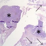 Fig. 3-B A photomicrograph (×20) showing portions of 2 of the nodules (*) with normal intervening synovium (arrows).

