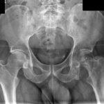 Fig. 1-A Patient pelvic radiograph misdiagnosed as simple left hip osteoarthritis.
