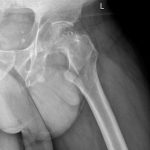 Fig. 1-B Patient left hip radiograph misdiagnosed as simple left hip osteoarthritis.
