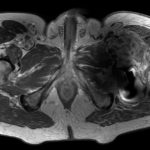 Fig. 3-B MRI showing a mass adjacent to the proximal part of the left femur.
