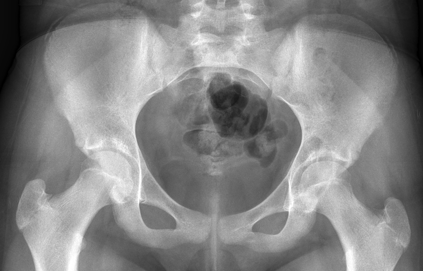 a-12-year-old-girl-with-hip-pain-jbjs-image-quiz