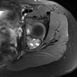Fig. 1-B Axial slice of a T2-weighted MRI of the left hip demonstrates a multiseptated lesion of the posterior acetabulum.
