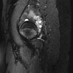Fig. 1-C Sagittal slice of a T2-weighted MRI of the left hip demonstrates a multiseptated lesion of the posterior acetabulum.
