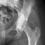 Fig. 2 An anteroposterior view radiograph of the left hip after intralesional curettage and grafting with synthetic bone graft substitute.
