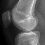 Fig. 4-B Lateral-view radiograph of the left knee demonstrates an eccentric, lytic lesion of the lateral metaphysis of the left proximal part of the tibia.
