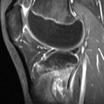 Fig. 4-D Sagittal view of a T2-weighted MRI of the left knee demonstrates a multiseptated lesion of the lateral metaphysis of the left proximal part of the tibia.
