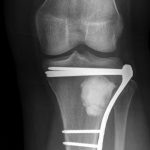 Fig. 5-A Anteroposterior-view radiograph of the left knee after intralesional curettage, grafting with synthetic bone graft substitute, and prophylactic internal fixation.
