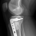 Fig. 5-B Lateral-view radiograph of the left knee after intralesional curettage, grafting with synthetic bone graft substitute, and prophylactic internal fixation.
