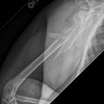 Fig. 1-B Lateral radiograph showing substantial displacement of a proximal humeral shaft fracture.

