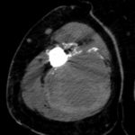 Fig. 2-A CT demonstrating a large hematoma in the medial compartment of the right arm.
