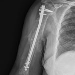 Fig. 4-A Anteroposterior radiograph 8 weeks after brachial artery reconstruction demonstrating robust callus formation of the humeral fracture.
