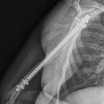 Fig. 4-B Lateral radiograph 8 weeks after brachial artery reconstruction demonstrating robust callus formation of the humeral fracture.
