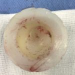 Fig. 4 Intraoperative photograph demonstrating the damage to the polyethylene liner.
