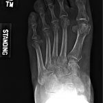 Fig. 2-A Radiograph showing the foot with chronic deformity with sclerosis, mild to moderate midfoot collapse, and moderate to advanced secondary degenerative arthrosis with periarticular diffuse osteopenia and diffuse soft-tissue swelling.
