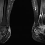 Fig. 4 T1-weighted coronal MRI of the bilateral tibia and fibula with contrast showing diffuse heterogeneous enhancement of the mass with invasion of the syndesmosis but limited proximal advancement.
