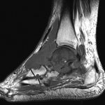 Fig. 6-A T1-weighted MRI of the left ankle without contrast shows T1 hypointense mass encompassing nearly the entire anterior ankle and proximal forefoot. Decreased T1 signal throughout the talus and navicular and, to a lesser degree, the anterior calcaneus.

