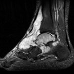 Fig. 6-B STIR MRI of the left ankle without contrast. Diffusely increased T2/STIR signal in the same distribution as the T1 study.
