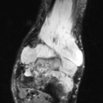 Fig. 7-B T2-weighted coronal MRI without contrast.
