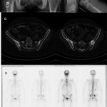 Fig. 1 Radiographs, CT scans, and bone scans of the patient. Fig. 1-A Anteroposterior pelvic radiograph. Sclerosis in bilateral ilium and proximal part of each femur. Fig. 1-B Anteroposterior and lateral radiographs of the distal part of the right femur. There is an increased density of the cortex in the distal part of the femur with an Erlenmeyer flask shape. Fig. 1-C CT scans of the pelvis revealing areas of trabecular irregularities and sclerosis in bilateral iliac bones. Fig. 1-D Bone scan. Grade-III signal in the anterior cranial fossa and the proximal and distal parts of each femur.
