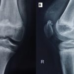 Fig. 1 Anteroposterior (Fig. 1-A) and lateral (Fig. 1-B) radiographs showing bony outgrowth from the superior pole of the patella with a large mass having focal areas of calcification
