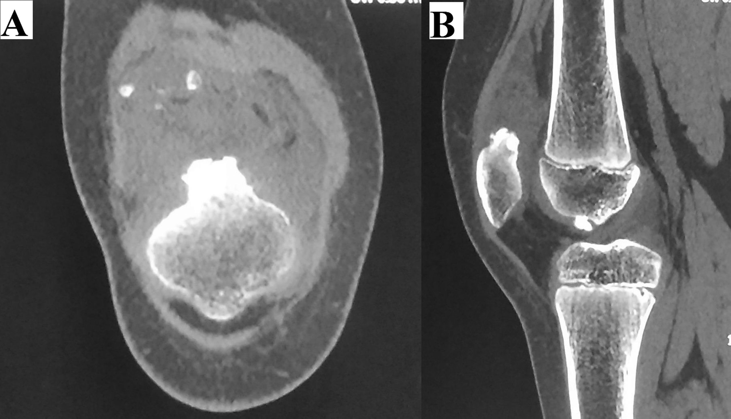 An 11 Year Old Boy With A Gradually Swelling Knee JBJS Image Quiz