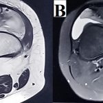 Fig. 4 MRI: T1-weighted axial image (Fig. 4-A) showing an isointense signal and T2-weighted image (Fig. 4-B) showing a heterogeneous signal suggestive of medial ossification center enlargement.
