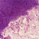 Fig. 6 Histopathology image (hematoxylin and eosin; ×40) showing the cartilaginous cap (red arrows) with underlying endochondral ossification (black arrows).
