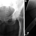 A 78-Year-Old Man with Acute Hip Pain