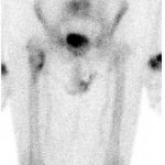 Fig. 4 Whole-body Tc-99 bone scan showing moderate increased radiotracer uptake on the medial cortex of the proximal part of the femur. Most of the lesions do not demonstrate increased activity.
