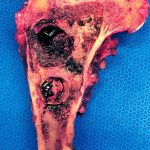 Fig. 6 Gross pathology specimen showing the tumor invading the medial cortex of the proximal part of the femur.
