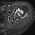 Fig. 6 Axial, T1-weighted, fat-saturated MRI of the left shoulder at presentation.

