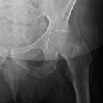 Fig. 1 Anteroposterior radiograph of the left hip demonstrating Tonnis-2 osteoarthritis without evidence of fracture.
