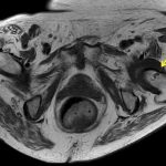Fig. 2 T1-weighted axial MRI demonstrating a nonspecific lesion of the left anterior femoral neck, indicated by the arrow.
