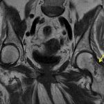 Fig. 3 T1-weighted coronal MRI demonstrating a nonspecific lesion of the left femoral neck (arrow).
