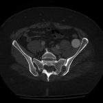Fig. 2-A Pelvic CT scan obtained 8 years postoperatively after left total hip arthroplasty showing axial projection.
