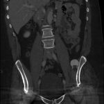 Fig. 2-C Pelvic CT scan obtained 8 years postoperatively after left total hip arthroplasty showing coronal projection.
