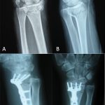 Fig. 1 Initial injury and postoperative radiographs demonstrating dorsally angulated extra-articular distal radial fracture. Preoperative anteroposterior (Fig. 1-A) and lateral (Fig. 1-B) radiographs. Postoperative lateral (Fig. 1-C) and anteroposterior (Fig. 1-D) radiographs after ORIF with volar plating.
