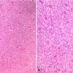 Fig. 4 Histological images. Fig. 4-A The image (×40) shows the lesion composed of a mixture of mononuclear cells and multinucleated giant cells. Fig. 4-B The image (×100) shows the similar nuclear morphology of the mononuclear and multinucleated giant cells.

