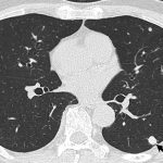 Fig. 8 Chest CT scan of a pulmonary nodular lesion (black arrow).
