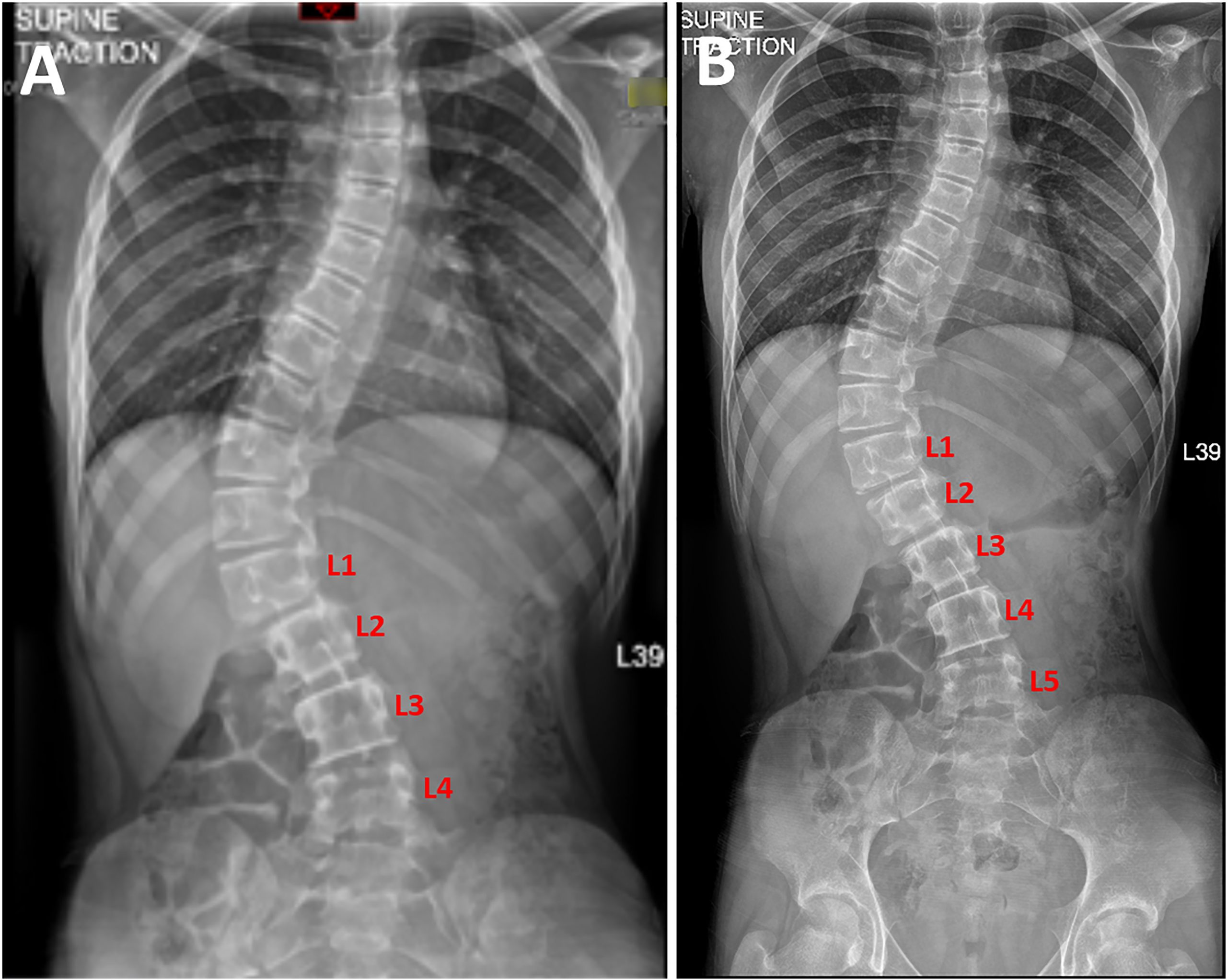 a-14-year-old-girl-with-adolescent-idiopathic-scoliosis-jbjs-image-quiz