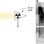 Fig. 4 Image stitching. Fig. 4-A Diagram of stitching radiograph acquisition. The patient stands between the x-ray machine and the flat panel detector or photographic plate. The detector moves up and down in unison with the x-ray emission tube to each exposure position. Fig. 4-B The composite image is assembled from the overlapping exposures of the thoracic spine and the lumbar spine.
