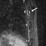 Fig. 2 Sagittal STIR image reveals increased signal in the eighth rib (arrow), with normal signal intensity in ribs 7 and 9 to 10.

