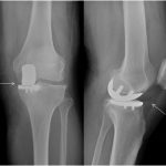 Fig. 1 Radiographs at first presentation: articulation between the femoral component and tibial tray (left) and anterior radiolucency (right), indicated by the white arrows.
