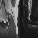 Fig. 3 Sagittal T1-weighted (left) and proton density fat saturation (right) MRI scans: anterior liner dislocation, effusion, and low signal foci in the thickened synovium representing metallosis, shown by the white arrows.
