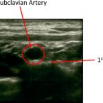 Fig. 3-A An ultrasonographic scan of a 15-year-old adolescent girl demonstrating a congenital first rib pseudarthrosis and its proximity to the subclavian artery.
