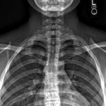 Fig. 5 Radiograph made 8 months after the injury showing bilateral first rib pseudarthrosis.

