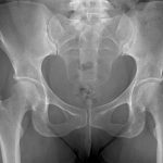 Fig. 1 Anteroposterior pelvic radiograph after the initial injury demonstrating no fracture or dislocations with only mild degenerative changes within the hip joint.

