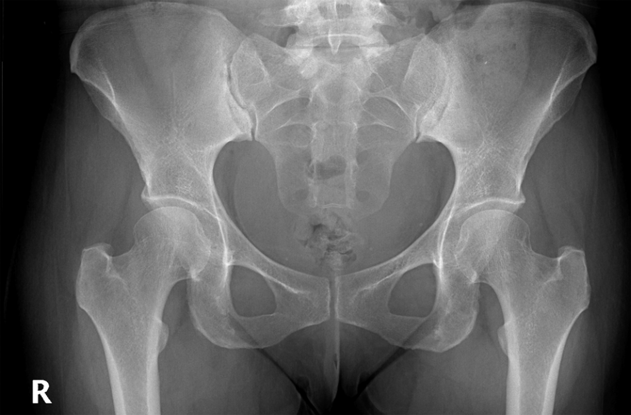 A 45 Year Old Woman With Worsening Hip Pain JBJS Image Quiz